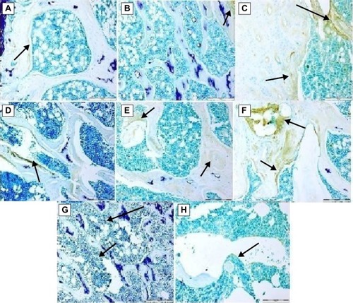 Figure 4 Immunohistochemical staining of polyclonal nuclear antigen-positive cells in bone tissue.