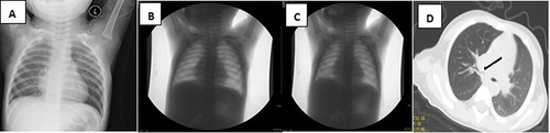 Figure 7 1-year 3 month-old girl was seen for 8 days for coughing and wheezing after choking on peanuts with no obvious abnormality seen on chest X-ray and chest fluoroscopy. Chest CT scan with airway reconstruction performed showed irregular, dotted soft tissue density foci in the proximal segment of the right main bronchus. Bronchoscopy was performed with several pieces of crushed peanuts noted and removed from the right main bronchus.