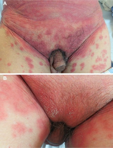 Figure 2 (A) Erythema and lots of tiny pustules on the abdomen. (B) Many pustules on the basis of erythema on the lower abdomen.