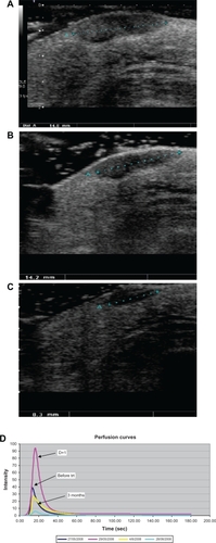 Figure 2 In transit melanoma metastasis treated by isolated limb perfusion in a good responder. Ultrasound B mode (gray scale) scanning of superficial subcutaneous hypoechoic nodule of the right limb. A) Before treatment, the lesion was 14.8 mm in size. B) At day 1 after treatment no significant morphologic change was observed (14.2 mm). C) At day 7, the lesion shows a significant decrease in size (8.3 mm). D) In the same patient, after modelling, perfusion curves expressed as linear raw data show an important increase in perfusion parameters at day 1 after treatment compared with baseline.