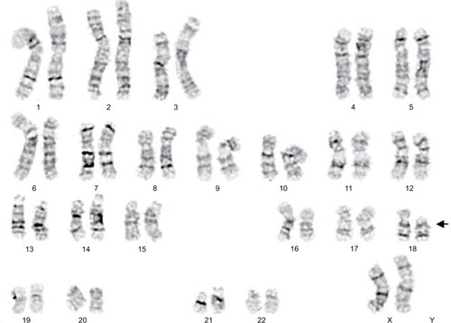 Figure 2 Chromosomal characteristics of the proband showing 18p deletion.