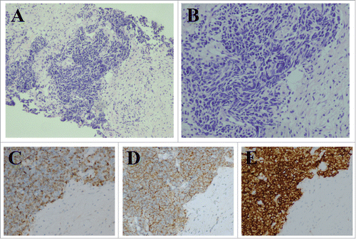 Figure 1. Pathological images from esophageal SCC. A. Hematoxylin-eosin stain (× 100). B. Hematoxylin-eosin stain (× 200). C.D.E. Immunohistochemical staining in esophageal SCC (× 200). Ki-67: 40%, Syn (+), CD56 (+).