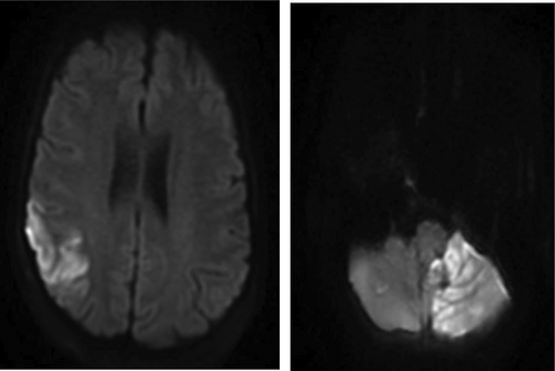 Figure 2. MRI brain showing acute ischemic edema involving the right posterior frontal parietal distribution.