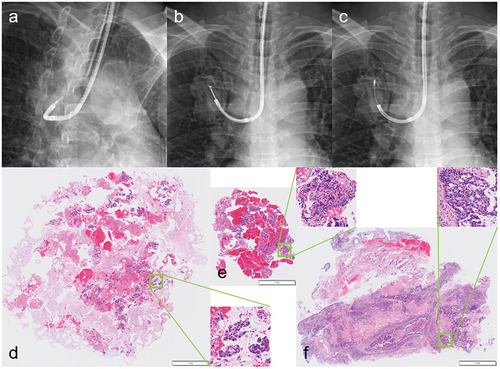 Figure 3. Differences in tissue specimens from each sampling method in the same patient with lung adenocarcinoma. following needle aspiration (a) to penetrate the bronchial wall, forceps biopsy (b) and cryobiopsy (c) were performed on the mass in the right upper lobe. Each histopathological image is shown in that order so that the magnification is the same between specimens (low-magnification images with magnified images of each square area). The aspiration needle specimen (d) is a so-called cell block, and the apparent volume usually seems large because fragmented cell clusters are mixed with other aspirated material. In contrast, the forceps biopsy and cryobiopsy specimens (e, f) are true tissues, with the latter clearly larger and less crushed than the former. (Unpublished data obtained from studies approved by the National Cancer Center Institutional Review Board (No. 2018-090). Comprehensive research consent was obtained from the patient and individual consent for this publication was waived.)