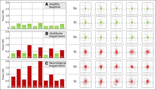 Figure 5 Eyes open (Eo) and eyes closed (Ec) phybrata power histograms (left) and anterior-posterior/medial-lateral (AP/ML) acceleration spatial scatter plots (right) for (A) baseline testing of 5 healthy athletes; (B) post-concussion testing of 5 athletes with vestibular impairments; (C) post-concussion testing of 5 athletes with neurological impairments.