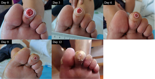 Figure 4 Representative images of the healing process in case 4.