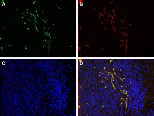 Figure 5 Ex vivo CNE-2 tumor tissue immunofluorescence staining of co-staining (D) of CD31 (A, green) and CD61 (B, integrin β3, red), and DAPI (C). Note: Magnification ×200.Abbreviation: DAPI, 4′-6-diamidino-2-phenylindole.