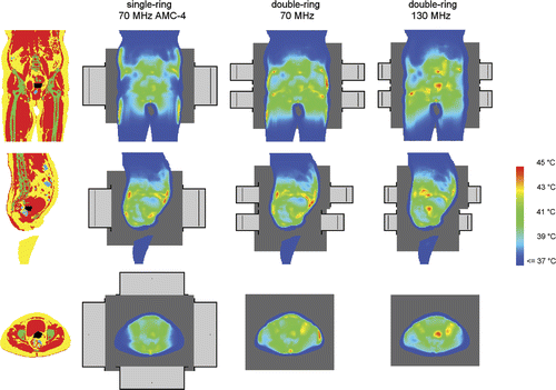 Figure 4. Coronal (top), sagittal (centre) and transversal (bottom) slices of the anatomy of patient 3 (left column). Red corresponds to muscle tissue, fat tissue is yellow, bone is green and inner air is blue. The tumour is represented by the black spot in the centre. The other three columns show the temperature distributions optimised for the 70-MHz AMC-4 system and double-ring systems at 70 and 130 MHz. Left and right of the patient correspond with right and left in these pictures, respectively. The orthogonal slices run through the centre of gravity of the tumour.