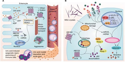 Figure 3 Schematic overview of the roles of ABCG2 in hyperuricemia and gout. (A) The ABCG2 transporter is highly expressed in the gut, where it regulates ATP-dependent uric acid excretion. The 141K ABCG2 variant leads to decreased surface expression, targeting of the misfolded protein to aggresomes and proteasomal degradation. In addition, the polymorphism increases miRNA-mediated degradation of mRNA. The resulting increase in circulating urate not only increases the risk of gout but can also induce a more pro-inflammatory state in monocytes due to epigenetic reprogramming.Citation129 Colchicine and HDAC inhibitors (HDACi) can restore 141K surface expression and function. (B) Monosodium urate crystals can induce mitochondrial damage, leading to the release of mitochondrial reactive oxygen species and DNA (mtROS, mtDNA), which in turn can activate the NLRP3 inflammasome. This can be limited through autophagy-mediated clearance of damaged mitochondria. ABCG2 plays a role in this process. In defective or diminished autophagy, p62 can accumulate, bind to keap-1, and induce translocation of Nrf2 to the nucleus. Nrf2 induces transcription of heme oxygenase-1 and superoxide dismutase (HO-1, SOD), which can also induce NLRP3 inflammasome activation.