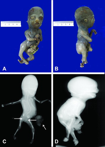 Figure 4.  (A–B). Gross picture of macerated fetus after formalin fixation showing club-feet deformity and an abdominal wall defect. The lower extremities are contracted. (C–D) Post-mortem antero-posterior and lateral x-rays showing severe levoscoliosis, widely separated ischial ossification centers (larger arrows), and external protrusion of abdominal contents (smaller arrow), and club foot deformity.