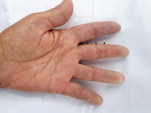 Figure 2 Acrocyanosis left IInd finger.