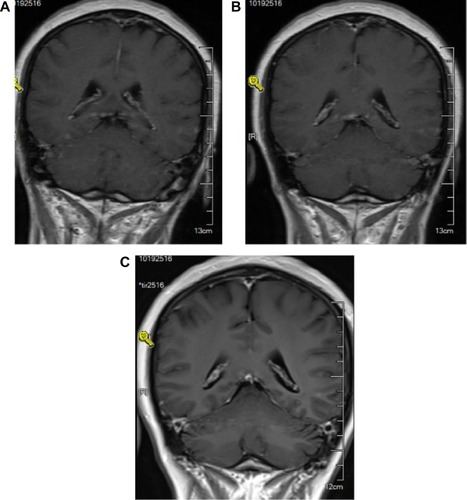 Figure 4 MRI scan of brain (scattered small nodules on the cerebellum and bilateral temporal lobe).