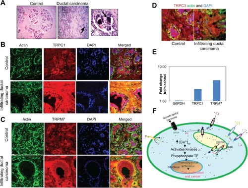 Figure 1 TRPC1 and TRPM7 expression is increased in infiltrating ductal carcinomas. Hematoxylin and eosin staining of control and ductal carcinoma samples. Respective images were taken at 10× zoom; microcalcification has been shown with an arrow, and also a magnified image showing microcalcification is provided on the right (A). Confocal images showing endogenous TRPC1 (B), TRPM7 (C), TRPC3 (D), and actin staining in age-matched controls (without cancer or microcalcifications) and infiltrating ductal carcinoma samples with microcalcifications were observed. Anti-TRPC1, Anti-TRPC3, or Anti-TRPM7 antibodies followed by rhodamine-conjugated secondary antibodies were used to detect endogenous TRPC1, TRPC3, and TRPM7 protein. Antiactin antibodies followed by FITC-labeled secondary antibodies were used to detect actin levels. The images provided are from at least two to three individual sections, and total fluorescence was evaluated using the Zeiss software (Carl Zeiss Microscopy, LLC, Thornwood, NY, USA). Fold change in the expression of G6PDH, TRPC1, and TRPM7 in controls, as well as breast cancer samples were observed (E). A model for the activation of various channels and their role in increasing cytosolic calcium that leads to cancer is shown (F).