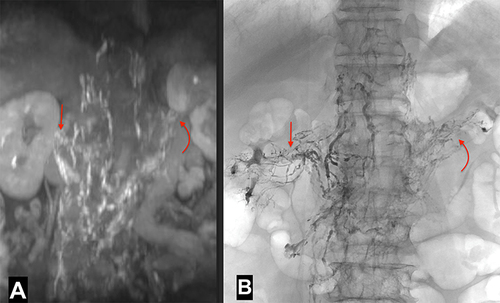 Figure 2 Comparison of MRL and IL in depicting the TD and urolymphatic fistula. A 62-year-old male with chyluria for 3 months. MRI (A) and IL (B) showed the dilated lymphatic vessel at the lumbar level and uro-lymphatic fistula at both kidneys (straight arrow on the right kidney and curved arrow on the left kidney).
