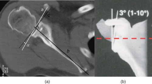 Figure 2. Current method of measuring version (a) and inclination (b) on CT scans.