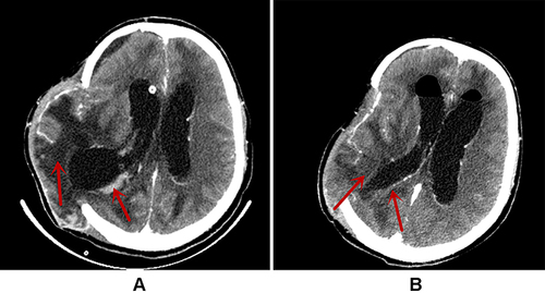 Figure 1 The brain CT images during hospitalization. (A) The Brain CT on January 13 (on postoperative Day 2); (B) the Brain CT on January 27 (on postoperative Day 17). The areas indicated by the red arrows in (A and B) are the sites of infection. After treatment, a significant improvement in infection was seen, as shown in (B).