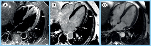 Figure 1. A 50-year-old male with acute myocarditis, who does not represent the typical age spectrum for male myocarditis, but was the oldest male patient we encountered so far at our center.(A) Triple-inverted T2-weighted fast spin echo (short tau inversion recovery) reveals epicardial hyperintense edema in the apical-lateral and basal-lateral wall (white arrows). The bright signal in the apical lumen represents slow flow, but not edema (black arrow). (B) The fast low-angle shot gradient echo late gadolinium enhancement (LGE) image with phase-sensitive reconstruction delineates focal fibrosis in the same location (white arrows). (C) The diastolic steady state free precession cine frame illustrates the extent of the lateral wall and confirms the epicardial location of the myocarditis lesions. There is a small rim of pericardial fluid, hypointense in (A) and (B), hyperintense in (C). There is a focal hepatic lesion: (A) bright in T2 and (B) hypointense in LGE and (C) cine, most likely representing a liver cyst.