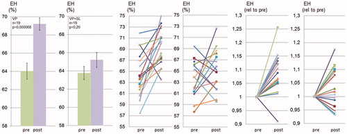 Figure 2. Spironolactone prevents vasopressin-induced endolymphatic hydrops in CBA/J mice. CBA/J mice were treated chronically with vasopressin for 28 d with or without SL and thereafter analyzed using MRI. Quantification of endolymphatic and perilymphatic cochlear compartments before and after vasopressin (VP) and before and after vasopressin plus spironolactone (VP + SL) administration was performed as described in Material and methods and in Figure 1. Data are presented as means (left), as individual values for each ear before and after treatment (middle) and as individual values for each ear with prevalues set to 1 (right).