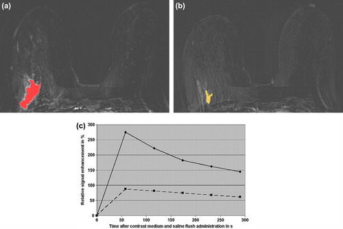 Figure 1. Invasive ductal carcinoma (G3) in the right breast of a 38-year-old patient before and after neoadjuvant chemotherapy (NACT). Before NACT, the CAD system coded the mass-like malignant lesion, but not the surrounding extensive intraductal component and the adjacent vessels (a), first subtraction image after contrast medium administration). The right breast reveals prominent vessels. After NACT, histopathology revealed persistent invasive ductal cancer (G3). The CAD system still coded the carcinoma, which size is decreased after neoadjuvant treatment (b), first subtraction image after contrast medium administration). The signal intensity time course of the hot spot region (c), i.e. the relative signal intensity in % over time in s, demonstrates before NACT a strong initial enhancement > 250% followed by a washout (continuous curve). After NACT, the signal intensity time course of the hot spot region (c) had an initial enhancement > 80% followed by a washout (discontinuous curve). Morphologically, the CAD system identified before and after NACT an irregular shape and a spiculated margin. The morpho-dynamix index, i.e. the probability of malignancy, decreased from initial 98% to 56% after NACT. Twenty-five months after initial breast cancer diagnosis, this patient suffered from bone, pleural, and liver metastases.