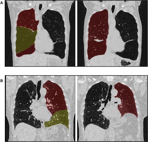 Figure 5 Representative exemplary CT images in the coronal plane of a patients with R <0.2 (A) and R ≥0.2 (B).