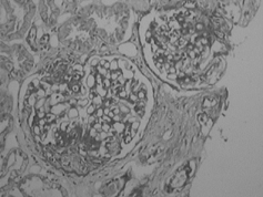 Figure 1. Kidney biopsy showing mesangioproliferative glomerulonephritis with mild increase in mesangial infiltration and patchy tubular atrophy. (Hematoxylin and Eosin, × 40).