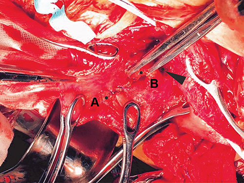 Figure 2 Pulling cervical lips and spiral suturing of lower uterine segment. (A) A continuous running spiral suture was made with I/0 vicryl suture starting around the internal cervical os in an outward direction in order to address any bloodspots. (B) The surgeon exposed the internal cervical os (black arrow), grasped the anterior and posterior cervical lips with straight Allis forceps to expose the lower uterine segment.