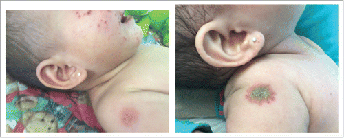 Figure 1. Mexican girl with erythematous papules (tuberculid) in the cheek and erythematous lesion in the BCG inoculation site that ulcerated 2 days later.