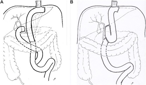 Figure 1 Scheme of postgastrectomy reconstructions.