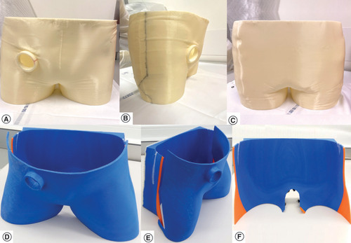 Figure 1. 3D-printed immobilization devices, embedding a static holder for the ultrasound applicator. (A–C) Immobilization device for the first volunteer. (D–F) Immobilization device for the second volunteer. (A & D) Front view. (B & E) Lateral view. (C & F) Backside view.