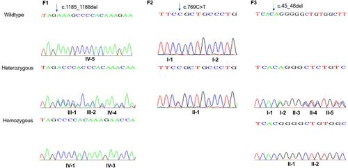 Figure 3 Sanger sequence chromatography for family F1 (left panel), family F2 (middle panel), and family F3 (right panel). In F1: the two probands (IV-1 and IV-3) have a pathogenic homozygous variant in SLC7A7 gene. Heterozygous carriers in the family are shown in middle part, while homozygous for the wild type allele is shown at the top. In F2 (middle panel): proband II-1 carries a de novo heterozygous variant in ACTG2 gene; whilst her parents carry the wild type homozygous allele. In the right panel, family F3, the two probands II-1 and II-2 have a homozygous deletion in HSD3B7 gene. While the parents along their children have the heterozygous allele.