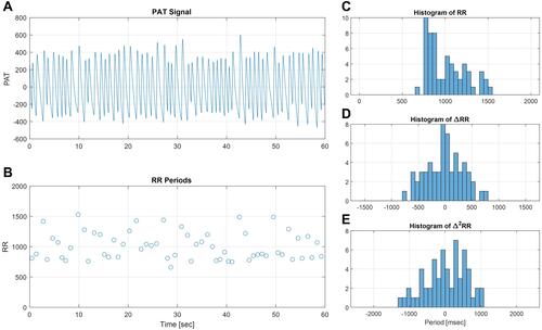 Figure 2 Atrial fibrillation. The PAT signal (A) and the chaotic pattern of heartbeats demonstrated in the RR sequence (B) is reflected in the wide, unimodal, and relatively flat distributions of RR periods and their derivatives (C–E).