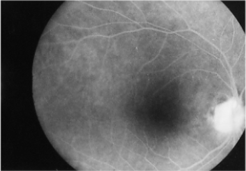 FIGURE 4 Right eye fundus fluorescein angiography after two months showing that the hyperfluorescence in the optic disc has disappeared.