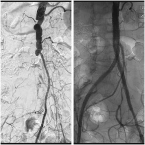 Left: Initial angiogram: Distal aortic occlusion with patent inferior mesenteric artery. Right: Completion angiogram: Covered endovascular reconstruction of the aortic bifurcation with snorkel to the inferior mesenteric artery.
