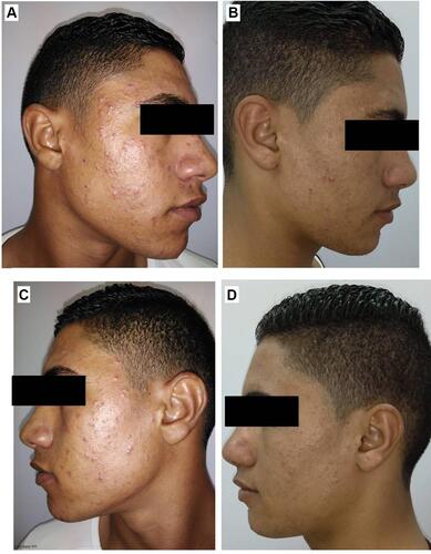 Figure 12 Right side of face before (A) and after topical tretinoin (B). Left side of the face before (C) and after ethosomal RP hydrogel (D).