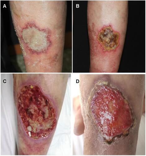 Figure 1 (A) An off-white patch with an erythematous halo localized in the left lower leg in size of 5×6 cm. (B) The lesion evolved to a painful ulcer with rapid growth in the next few days. (C) Surgical debridement was performed and all of the devitalized tissues were removed. (D) The lesion after debridement for 2 months.