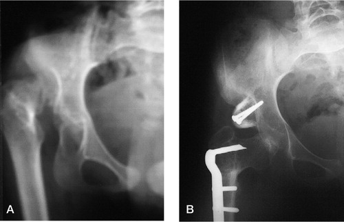 Figure 4 Case 12. A 15-year-old girl at the index operation (A) for dislocation of the right hip and after open reduction (B), capsulorrhaphy, extraarticular grafting arthroplasty and femoral shortening, showing adequate reduction at 28 months of follow-up.