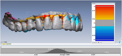 Figure 6. Three-dimensional (3 D) superimposition. The postmortem (PM) surface is superimposed on the antemortem (AM) surface. In this case, scans were secured by a low-resolution medical CT scanner with an approximately 0.3 slice thickness. Surfaces matching within a region of 0.5 mm are coloured grey, while those that fall outside this range (mainly soft tissues) are coloured according to the degree of mismatch. With modern intraoral scanners, the resolution and scan precision are much higher, so the width of the grey zone can be reduced to a level measured in tens of microns, providing excellent individuation. (Image courtesy Ms Donna MacGregor and Mr Mark Barry, with permission).