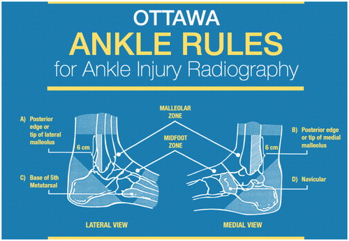 Figure 2. Ottawa ankle rules: Areas of palpation. Source: Ottawa Hospital Research Institute (http://www.ohri.ca/). Reprinted with permission of Ian Stiell of the Ottawa Hospital Research Institute.
