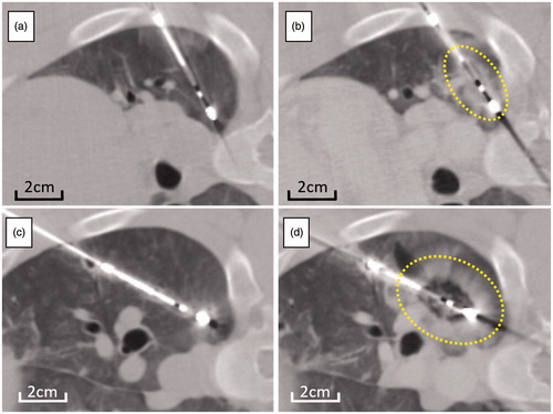 Figure 1. Serial change of CT image following microwave ablation at high power. CT images taken before ablation (a,c) and within 10 min after ablation (b,d) for short (a,b) and long (c,d) duration energy delivery. Compared with CT before ablation (a, c), low density area appeared around the electrode, surrounded by ill-demarcated consolidation on CT immediately after both short (b) and long duration (d) energy delivery. Ablation after long duration (d) treatment appears more spherical when compared to short duration (b) of energy delivery. Dotted lines demarcate the ablation zone from untreated lung.