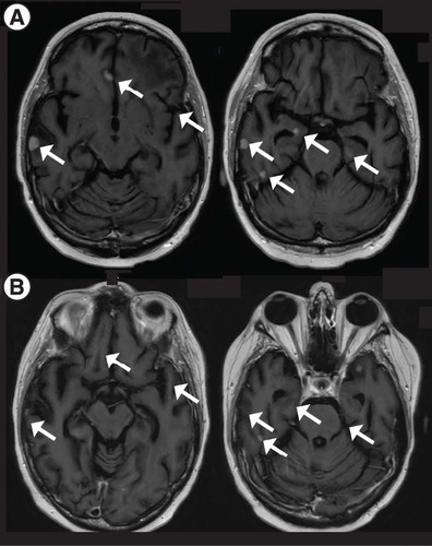 Figure 3. Multifocal brain metastasis response to T-DXd with rechallenge. Post contrast T1-weighted MRI showing (A) progression of CNS disease in the setting of a T-DXd holiday and (B) improvement of most lesion upon T-DXd reinstatement (2 months after (A)). Each arrow indicates a metastasis that resolved after treatment initiation.TDXd: Trastuzumab deruxtecan.