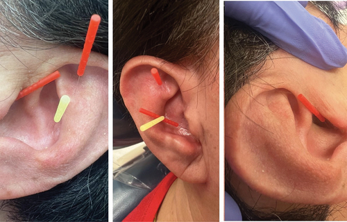 Figure 3. Acupuncture needle placement on bilateral ears (left and middle image: left ear/right image: right ear).