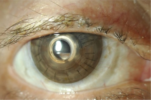 Figure 3 Bandage contact lens tinted to match the fellow iris and improve cosmesis.
