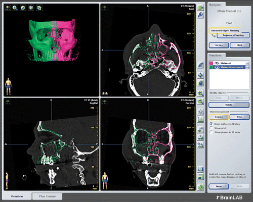 Figure 6. Intra-operative planning. Digital template on the side repaired first (violet) superimposed on the fractured side in two and three dimensions in the original CT scans, resulting in an ideal and symmetrical positioning of the bones (green).