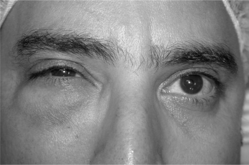 Figure 1 Swelling of the right lower eyelid due to the tumor in the anterior inferior orbit.