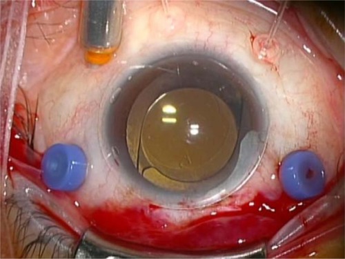 Figure 3 Application of the lens on the cornea without a lens fixating ring.