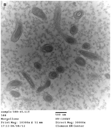 Figure 6 (A) Transmission electron microscopy (TEM), demonstrating longitudinal section of filament from patient 4. Note hollow medulla surrounded by a cortex. Scale bar is shown at bottom of TEM. (B) TEM of bovine digital dermatitis (BDD) section showing both longitudinal and cross sections of spirochetes. Scale bar is shown at bottom of TEM.