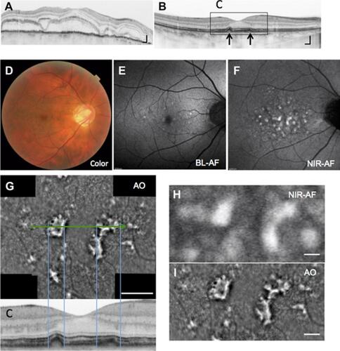 Figure 2 Right eye of a 43-year-old man with Vogt-Koyanagi-Harada disease (case 2). (A) Horizontal spectral-domain optical coherence tomography (SD-OCT) image of the fovea before steroid treatment. bar =200 μm. (B, C) SD-OCT image at 18 months from baseline. Elevation and thickening of the RPE layer were observed near the fovea (arrows). bar =200 μm. Color fundus photograph (D) Blue-light fundus autofluorescence (BL-AF) (E) Near-infrared fundus autofluorescence (NIR-AF) (F) images of the fundus at 18 months from baseline. Slightly hyper-autofluorescence in the BL-AF and hyper-autofluorescence in NIR-AF image was observed. (G) The AO panorama image of fovea (bar =500 μm). Hyper-reflective lesions in AO images are corresponding to the elevation or thinking of the RPE layer in the OCT. Enlarged images of NIR-AF (H) and AO image (I) of the fovea (image size 2.2×1.1 mm). In the AO image, the boundary of the lesion was clearer. bar =200 μm.Abbreviations: RPE, retinal pigment epithelium; AO, adaptive optics.
