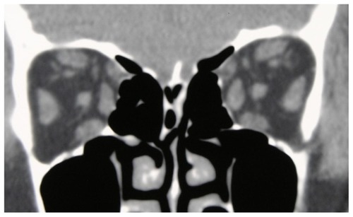 Figure 3A Coronal computed tomography of the orbits shows bilateral enlargement of the inferior rectus muscle, medial rectus muscle, superior oblique muscle, and superior rectus muscle-levator muscle complex.