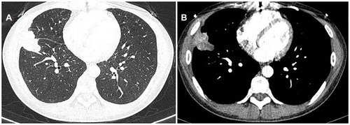 Figure 4 Case 2. CT findings in the right middle and inferior pulmonary lobe. (A and B) A 3.9cm×2.9cm lobulated mass without pleural effusion was found was after four months of anti-tuberculosis treatment.