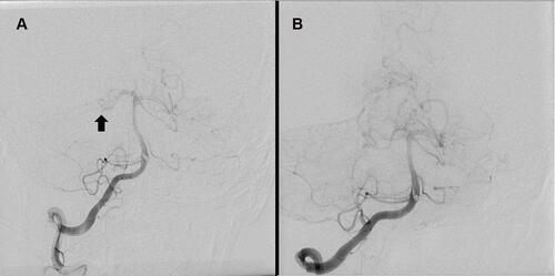 Figure 2 Digital subtraction angiography (A) before thrombectomy shows right P1-P2 occlusion (arrow), and (B) after thrombectomy shows near complete perfusion with TICI 2b.